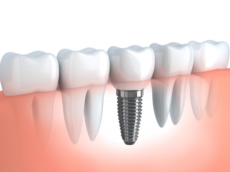 Dental Implants  Louisville, CO 